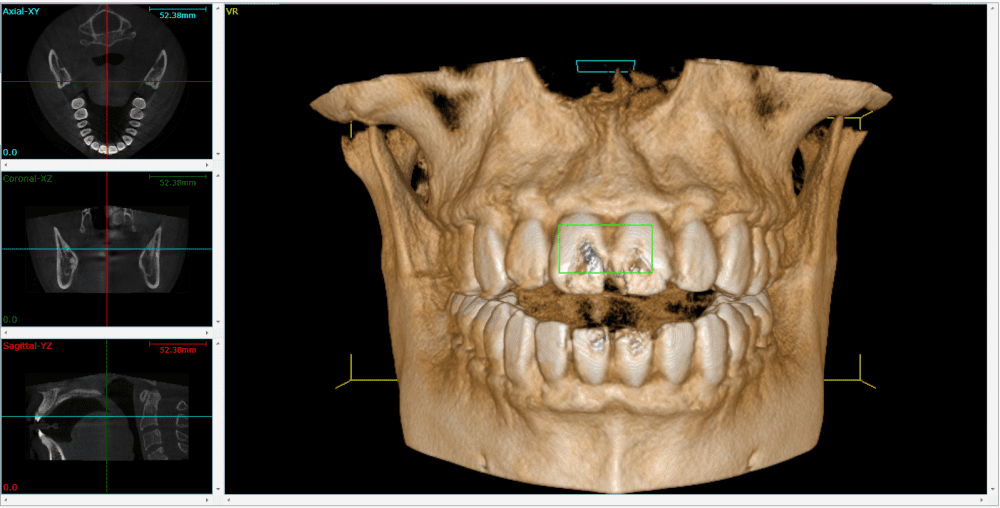 CBCT