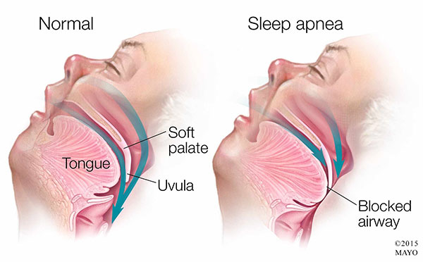 lubbock tx sleep apnea osa and usar therapy